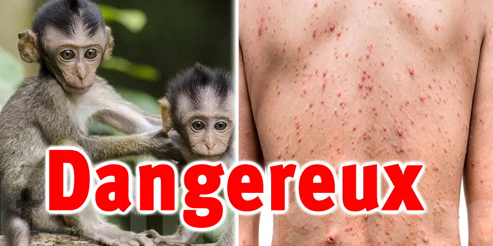 Variole du singe : 1500 cas coonfirmés dans un pays proche 